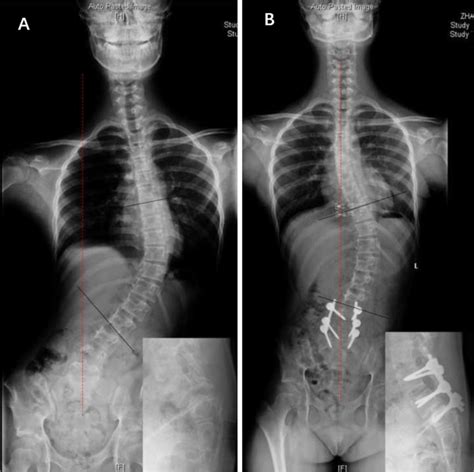 Radiology Of Scoliosis And Spondylolisthesis Dc Hours
