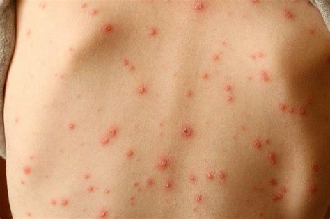 Skin Rash Should Be Considered Key Symptom Of Coronavirus Say Scientists