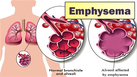 Emphysema I Causes Symptoms Prevention And Treatment Youtube