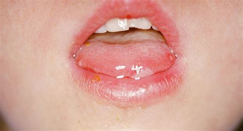 Infection is spread from person to person by direct contact with nose and throat discharges, saliva, fluid from blisters, or the stool of infected persons. Hand, foot and mouth disease in babies - BabyCenter Australia