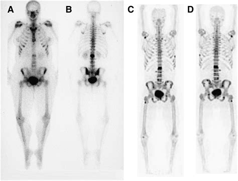 An Introduction To Na18f Bone Scintigraphy Basic Principles Advanced