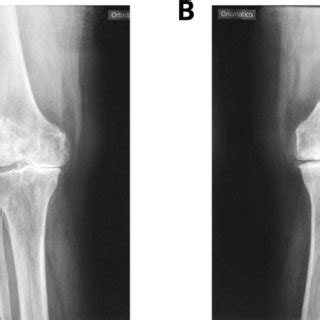 Knee X Ray A Right Knee Osteoarthritis Kellgren Lawrence Grade