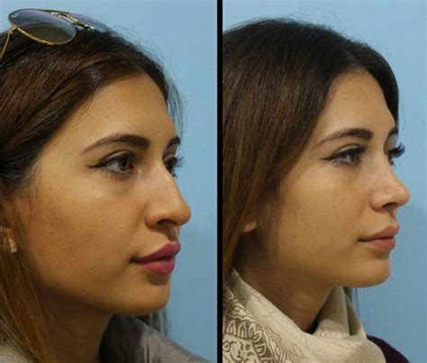 There are surgeries that can attempt to correct the hump, but these can be risky. nose hump removal pictures (2) » Rhinoplasty: Cost, Pics, Reviews, Q&A