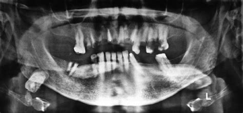 Orthopantomograph Images Revealed Multiple Unilateral Salivary Stones