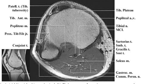 Figure From Normal Mr Imaging Anatomy Of The Knee Semantic Scholar