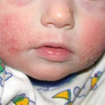 Check spelling or type a new query. Pictures of Skin Allergies in Children