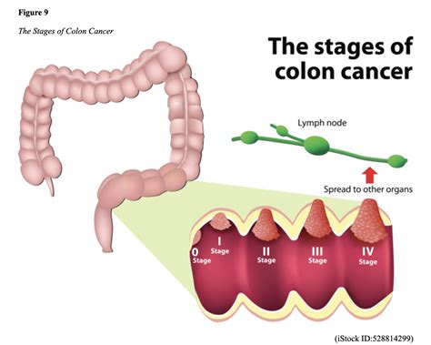 Colon Cancer Prevention Diagnosis And Management For Rns And Lpns