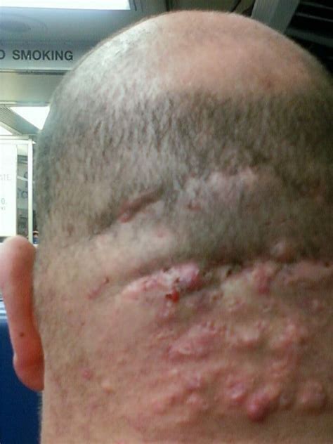 Both are often caused by hormonal changes. Home Remedies Acne on the Scalp - Hair Natural Treatment