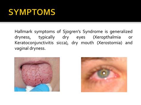 Ppt Sjogrens Syndrome Powerpoint Presentation Id2089181