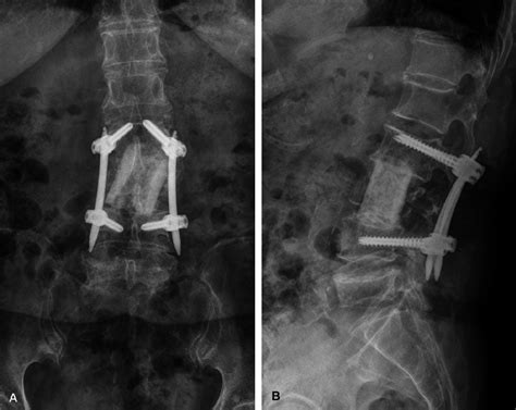 A Ap And B Lateral Radiographs Which Were Taken After 2 Years Of