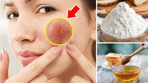 Remove Dark Spots On Face Naturally Overnight Natural Remedy 100