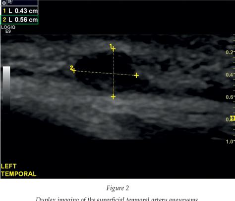Figure 2 From Ultrasound Diagnosis Of A Temporal Artery Aneurysm