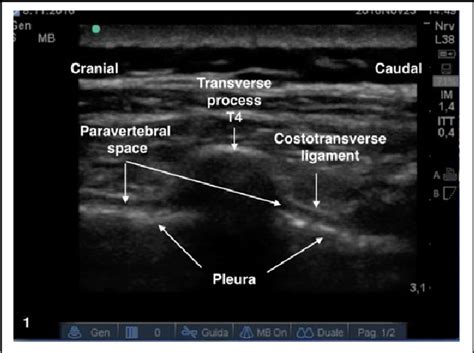 Real Time View Of Anesthetic Solution Spread During An Ultrasound