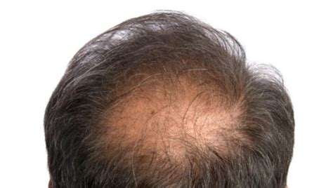 Hair Loss Causes Of Hair Loss Symptoms And Treatments