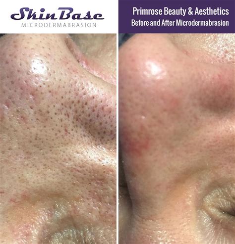 Microdermabrasion Before And After Skinbase™ Facial