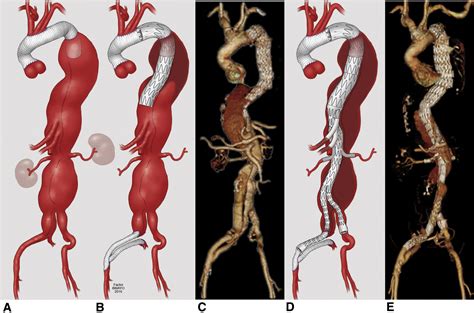 Supplemental Materials For Endovascular Repair Of Thoracoabdominal