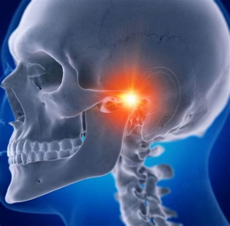 Tmj Headache Causes Symptoms And Treatment Amy Burkhart Md Rd