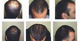 Pictures of Can Collagen Help Regrow Hair