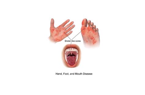 Hand Foot And Mouth Disease Hfmd Emergency Management
