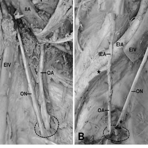 Pdf Variant Origin Of Obturator Artery A Branch Of Inferior