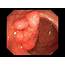 Colon Polyp Size And Cancer  Graphicdesignerjacksonvillenc