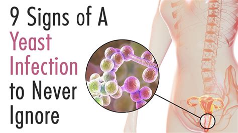 Signs Of A Yeast Infection To Never Ignore Yeast Infection Cure Yeast Infection Symptoms