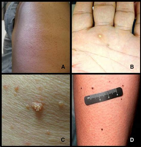 Examples Of Skin Toxicities A Keratosis Pilaris Like Eruptions B