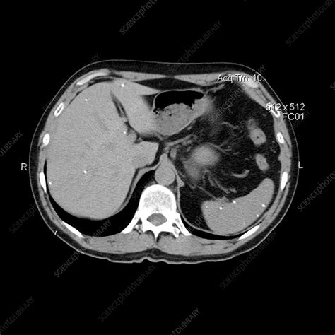 Ct Of Upper Abdomen Stock Image M1650338 Science Photo Library