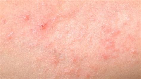 Prickly Heat Treatments Causes And More Scabiesborax Prickly Heat