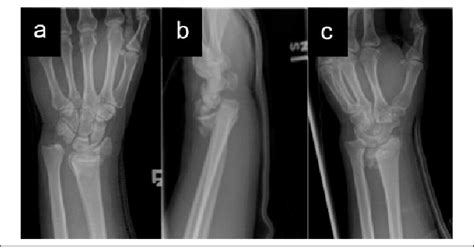 Plain Radiographs Of The Left Wrist At The Time Of Initial
