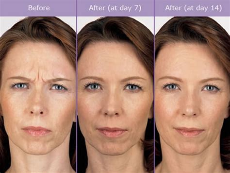 Botox Frown Lines Before And After