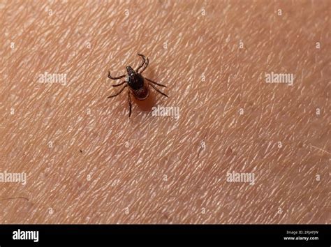 Infected Female Deer Tick On Hairy Human Skin Ixodes Ricinus