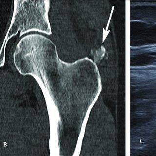 Pdf A Case Of Bilateral Acute Calcific Tendinitis Of The Gluteus Medius Treated By Ultrasound