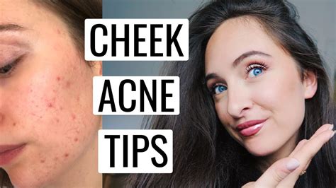 How To Get Rid Of Acne On Cheeks Causes And Treatments