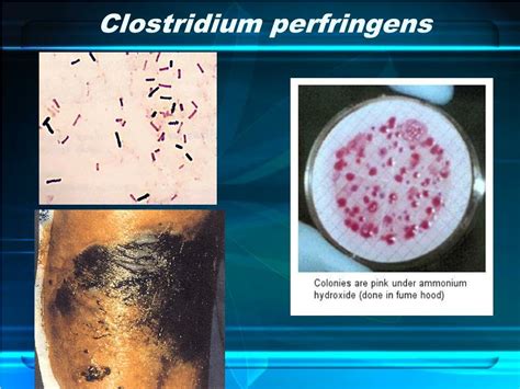 Clostridium Perfringens Symptoms