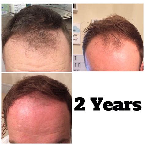 Finasteride For Hair Loss Results Propecia Finasteride Hair Transplants Hair Loss Restoration