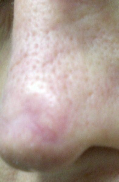 What Is The Process To Remove Bumps On Nose Tip Photo Doctor Answers