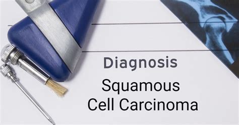 What Is Squamous Cell Carcinoma Facty Health