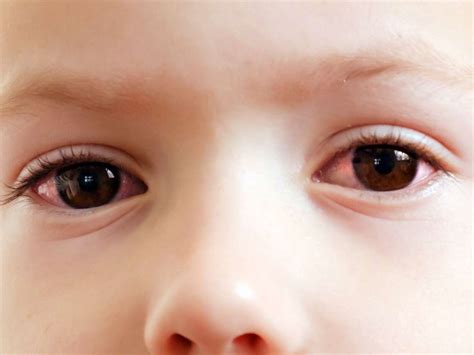 Pink Eye In Toddlers Symptoms Diagnosis And Treatment Medical News