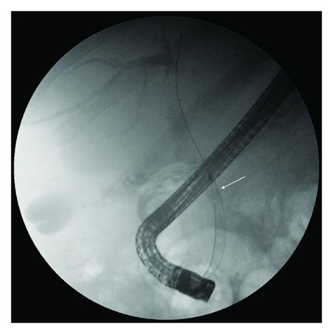 Ercp Demonstrating The Biliary Extraction Basket Around A Stone Arrow