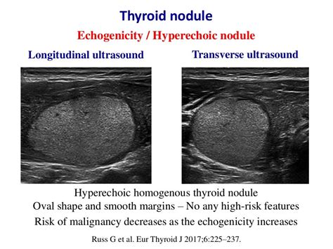Ultrasound Of Thyroid Nodules