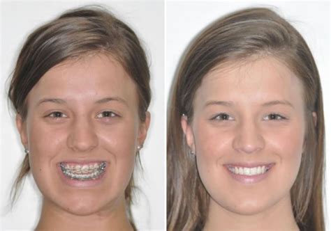 Case 6 Upper And Lower Jaw Surgery Sydney Oral And Facial Surgery