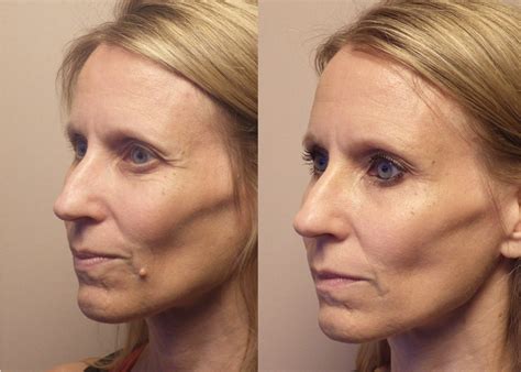 Mole Removal Photo Patient Guyette Facial Oral Surgery Center