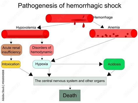 Schematic Pathogenesis Of Hemorrhagic Shock Stock Vektorgrafik Adobe Stock