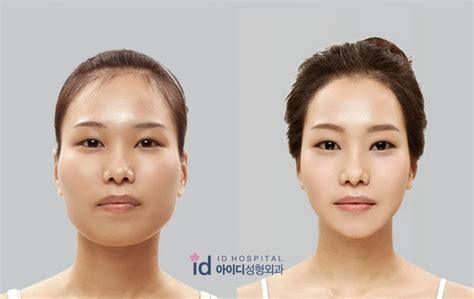 Id Hospital Korea What Is Cheekbone Reduction Surgery And Why Do We