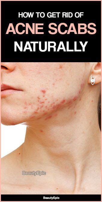 How To Get Rid Of Acne Scabs Acne Scab Back Acne Treatment How To