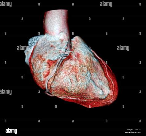 Coloured 3d Computed Tomography Ct Scan Of The Heart Of A 54 Year Old