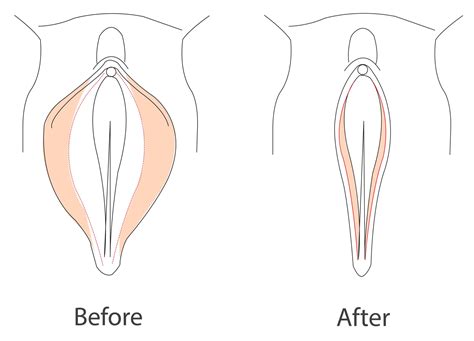 enlarged labia causes symptoms and treatments labial hypertrophy