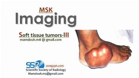 Soft Tissue Tumors Part 3 Profmamdouh Mahfouz 2019 Edition