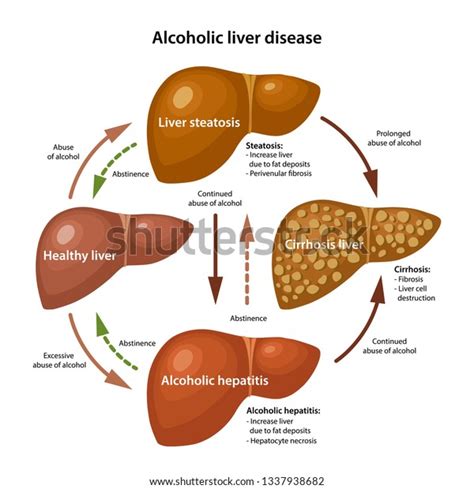 Liver cirrhosis is an abnormal liver condition in which there is irreversible scarring of the liver. Stages Alcoholic Liver Disease Description Corresponding ...